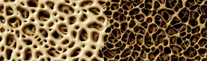 Medical Osteoporosis Fact