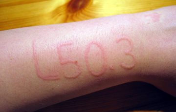 Dermatographism allergy