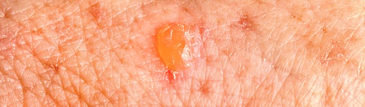 Interesting Skin Cancer Fact