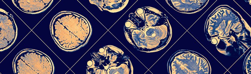 Parkinson Disease Facts